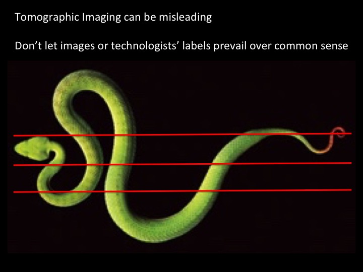 Figure 5 for case distal tendon of biceps brachii ( RID2065 )
